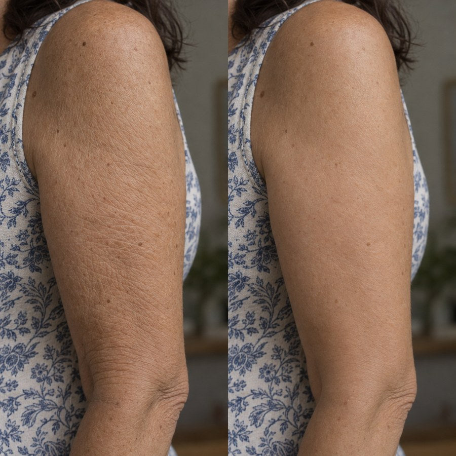 Primer plano de la parte de atrás del brazo: a la izquierda la piel arrugada y apagada, a la derecha lisa y uniforme