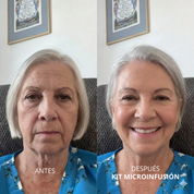 Kit de Microinfusión Facial: Rejuvenecimiento y Firmeza