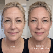 Kit de Microinfusión Facial: Rejuvenecimiento y Firmeza
