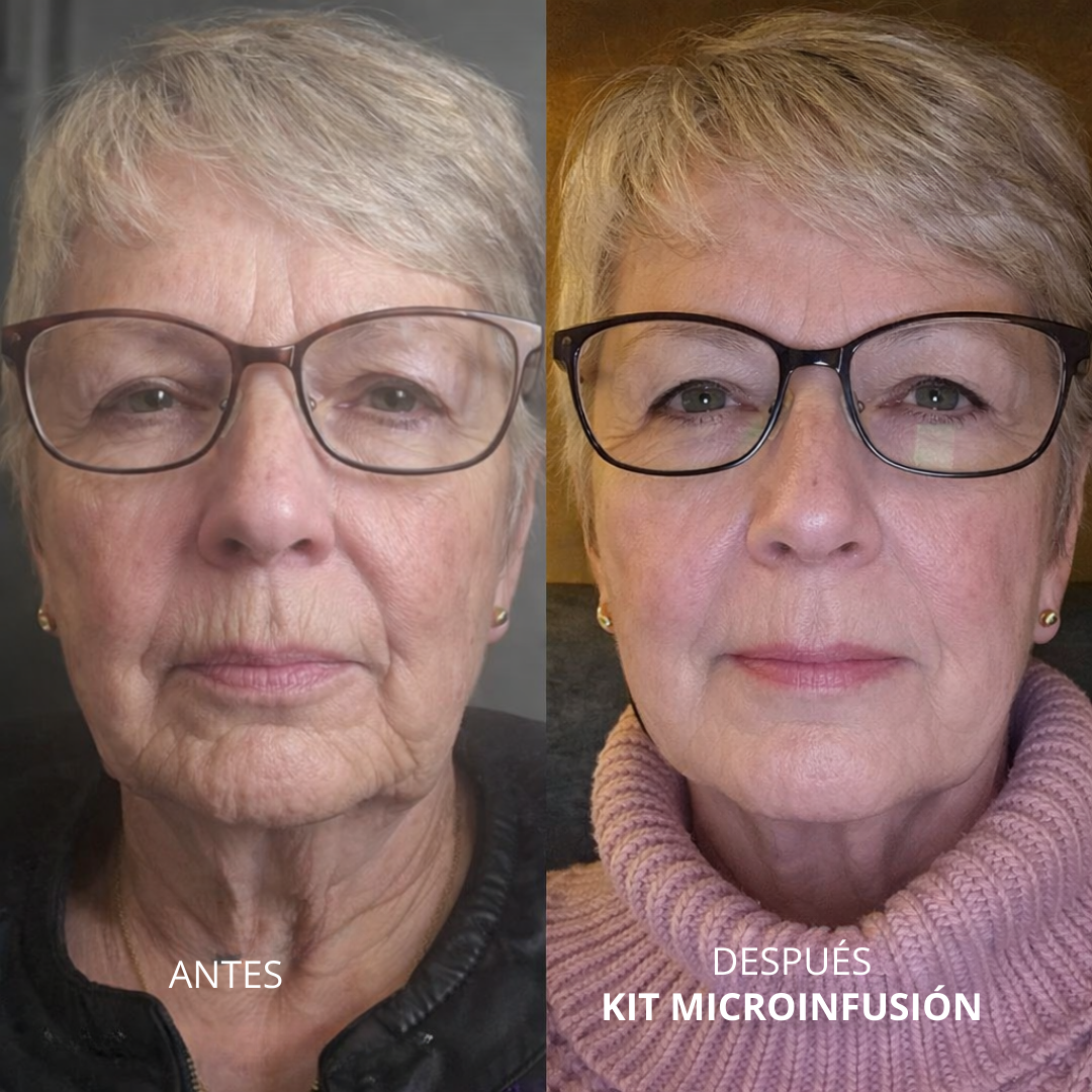 Kit de Microinfusión Facial: Rejuvenecimiento y Firmeza