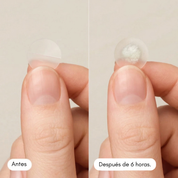 Parches Antiacné Efecto Rápido