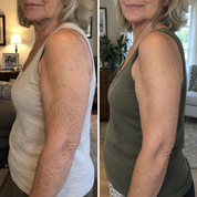 Antes y después: el brazo de una clienta con la piel más firme