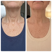 Antes y despues ilustrativo del aspecto de las manchas en cuello y escote. Imagen ilustrativa, no es una clienta real. Los resultados varian.