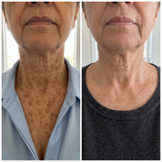 Antes y despues ilustrativo del aspecto de las manchas en cuello y escote. Imagen ilustrativa, no es una clienta real. Los resultados varian.