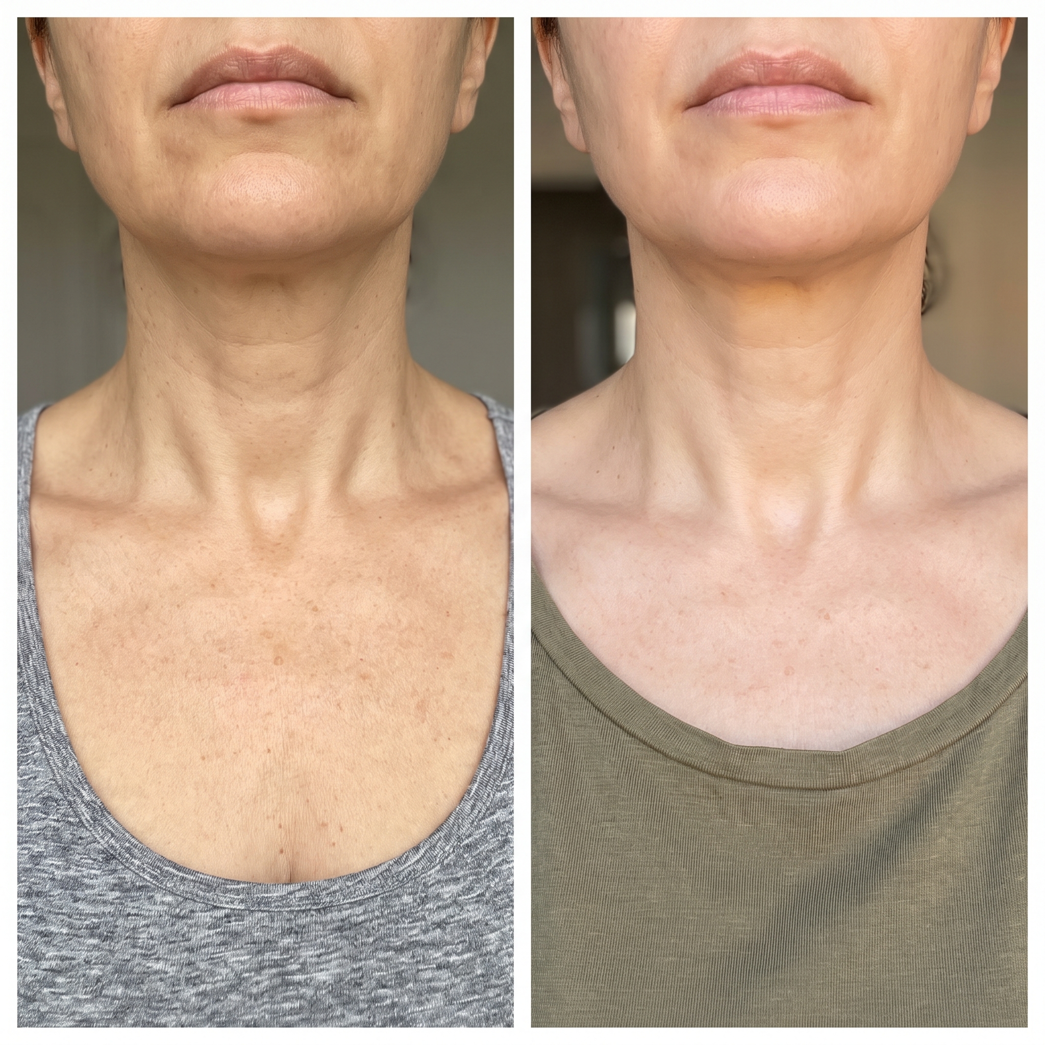 Antes y despues ilustrativo del aspecto de las manchas en cuello y escote. Imagen ilustrativa, no es una clienta real. Los resultados varian.