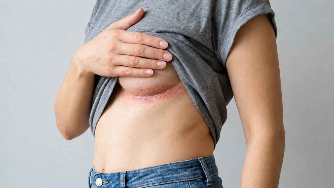 Sarpullido e irritación en el pliegue debajo del pecho