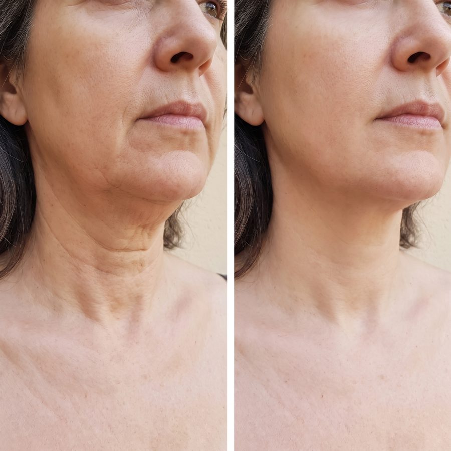 Antes y después del cuello y la mandíbula de una mujer de unos 56 años: a la derecha la piel se ve más lisa y firme