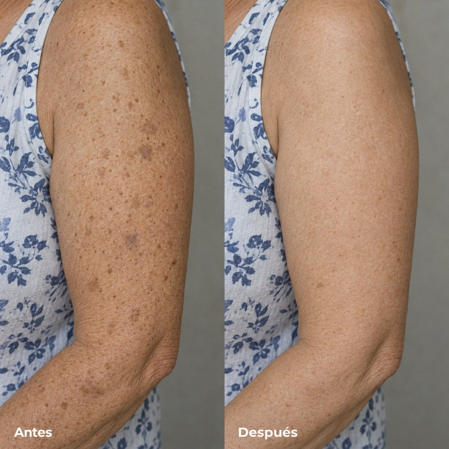 Brazo con manchas de la edad etiquetado «Antes» junto al mismo brazo con el tono mucho más uniforme, «Después»