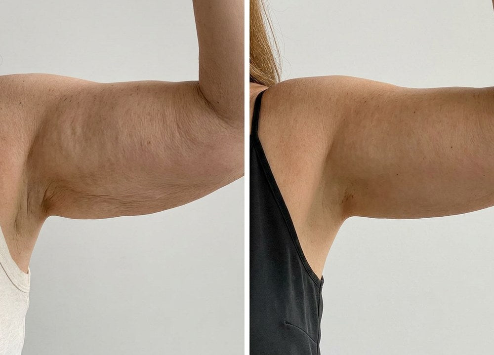 Comparativa del brazo antes y después