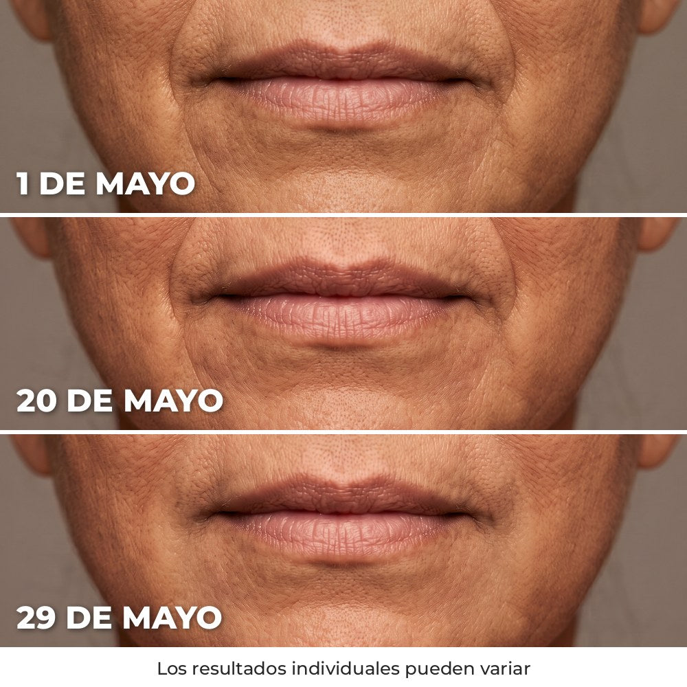 Evolución del surco de la sonrisa del 1 al 29 de mayo