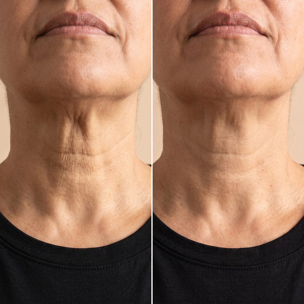 La barbilla y el cuello antes y después