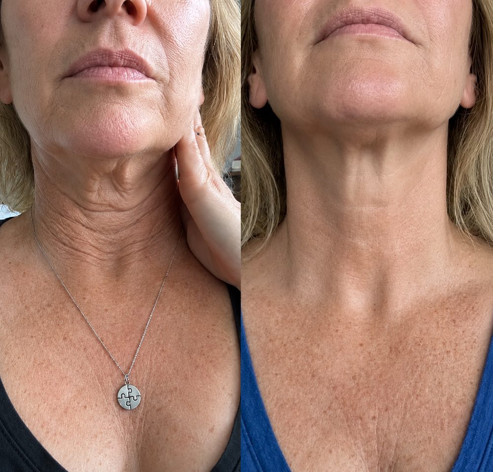 El cuello y la papada, antes y después